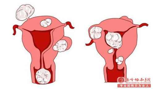 金华子宫肌瘤危害女性健康的杀手