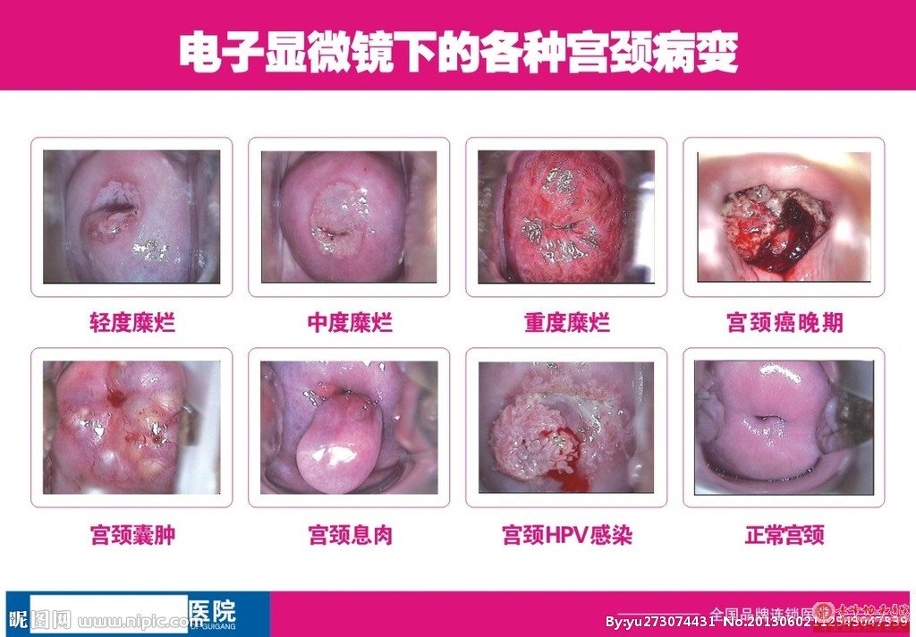 金华宫颈肥大要做哪些检查？