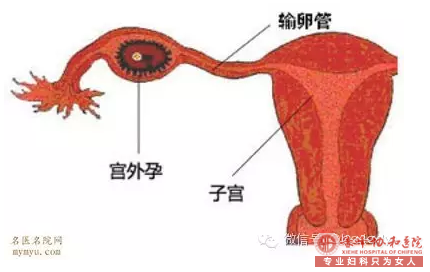 金华松山面对宫外孕，其症状和手术你都知道了吗?