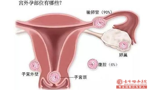 翁牛特旗宫外孕的早期有些什么样的症状？