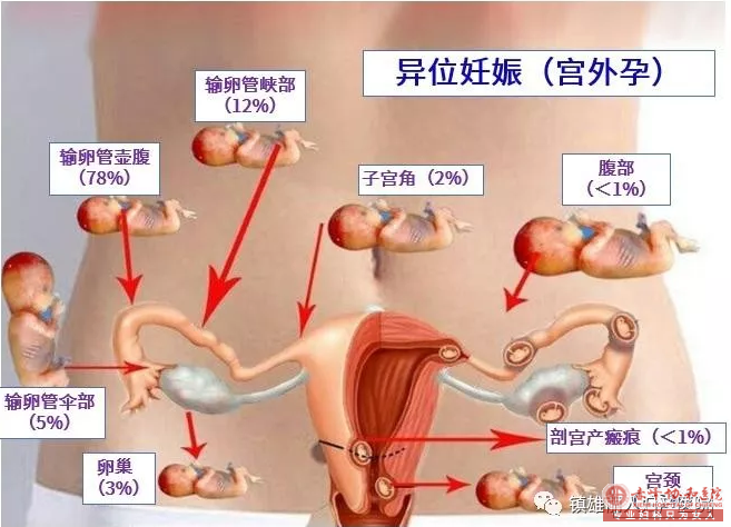 红山区什么导致了宫外孕，又通过什么发现宫外孕?